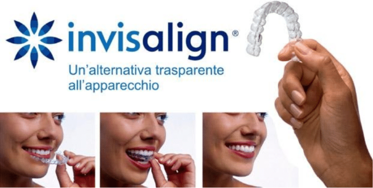 Invisalign - Dentista Fabrizio Riva